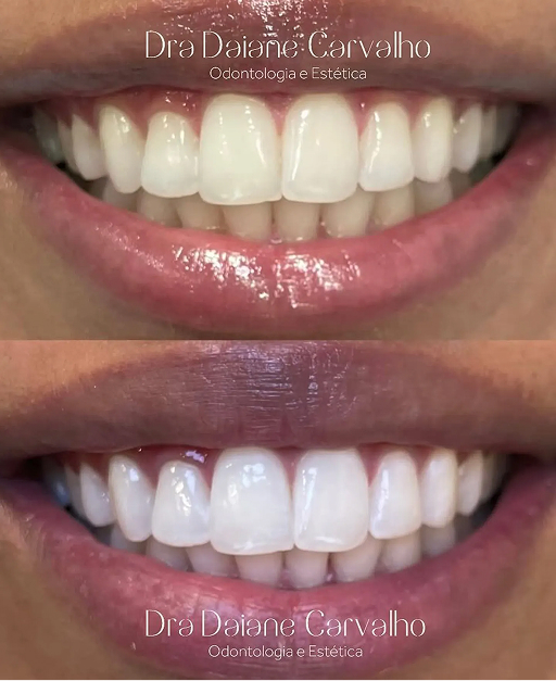 Resultado de clareamento dental