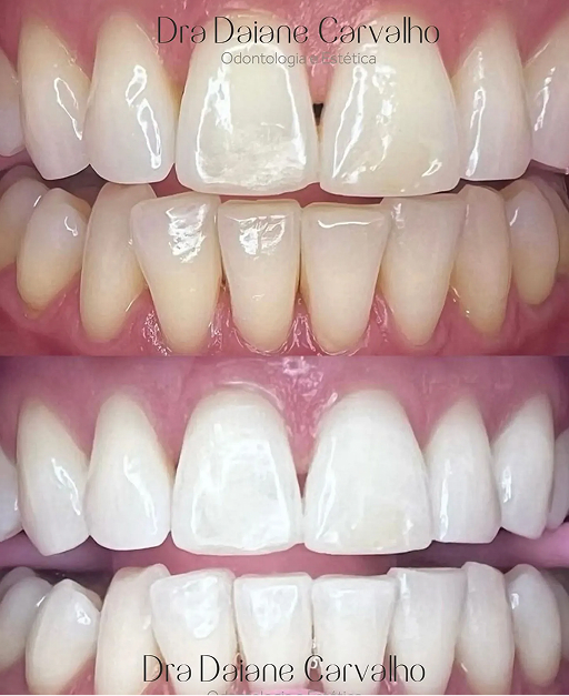 Resultado de clareamento dental