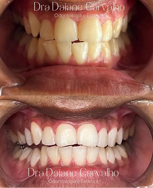 Resultado de clareamento dental