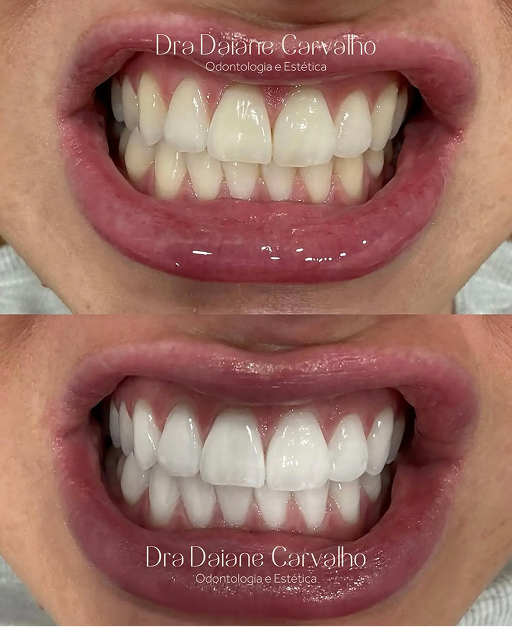Resultado de clareamento dental