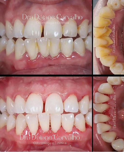 Resultado de clareamento dental
